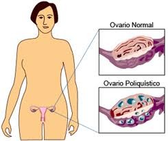 comment traiter dystrophie ovarienne